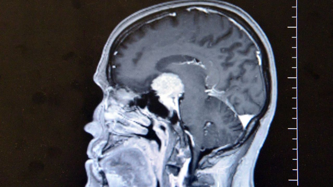 Beynindeki milyonda bir görülen tümör, KSÜ’de ameliyatla alındı