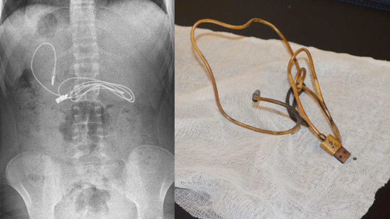 15 yaşındaki çocuğun midesinden 1 metrelik şarj kablosu ve toka çıktı