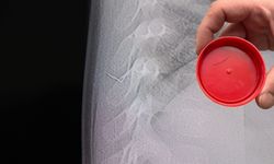 Kahramanmaraş'ta bebeğin sırtından tel parçası çıktı