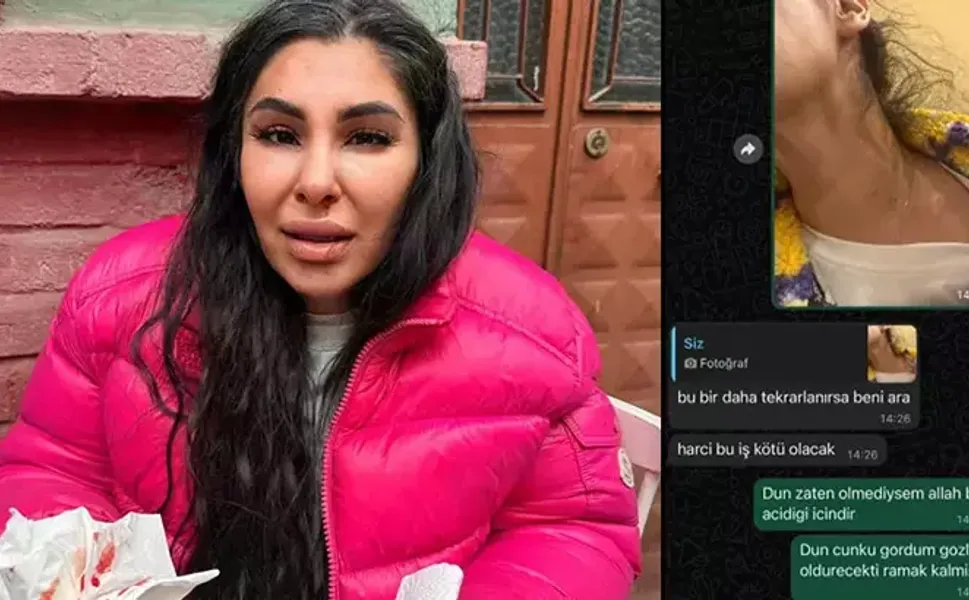 İlişkisini bitirmek istedi darbedilip burnu kırıldı: Yaşamak istiyorum