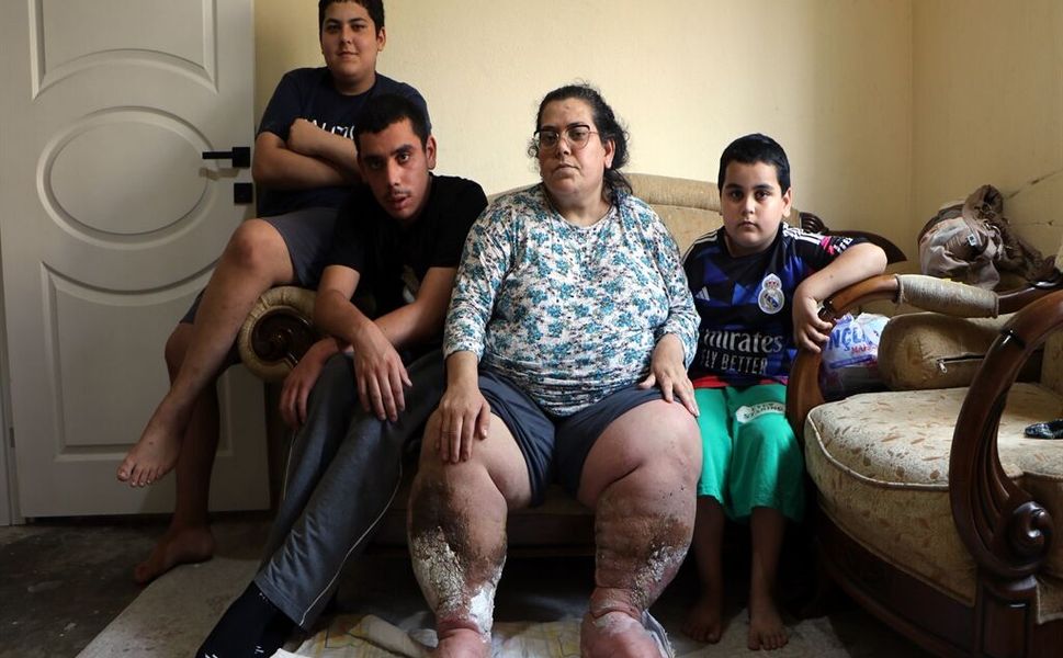 Fil hastası kadın, iyileşip çocuklarıyla ilgilenmek istiyor
