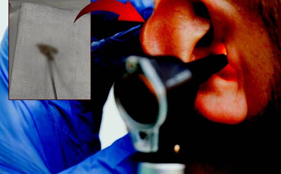 Kulağındaki kıpırtıyla doktora koştu İçinden çıkan canlıyı görünce doktorlar bile inanamadı!